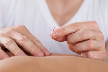 Acupuncture