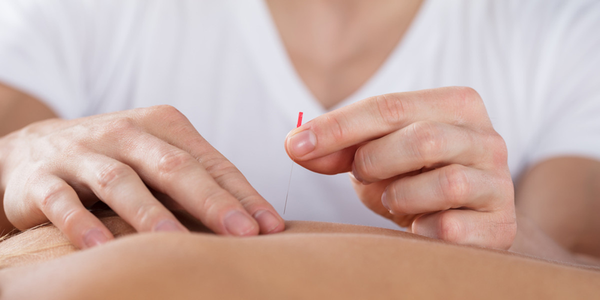 Acupuncture